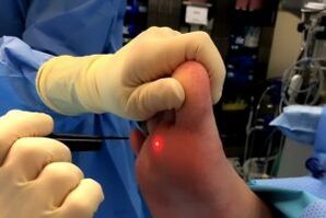 Métodos cirúrxicos para eliminar as verrugas