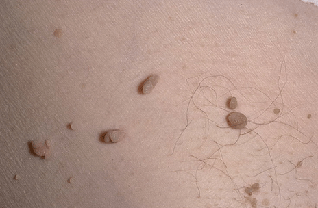Papiloma