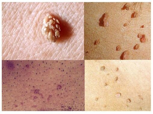 verrugas xenitais no corpo