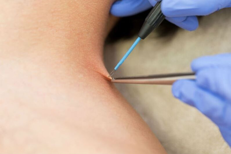 O procedemento para eliminar o papiloma mediante electrocoagulación
